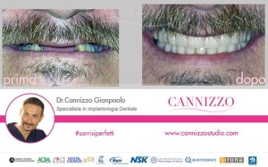 denti fissi subito