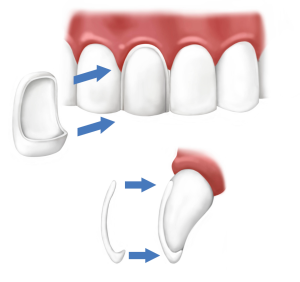 faccette dentali applicazione