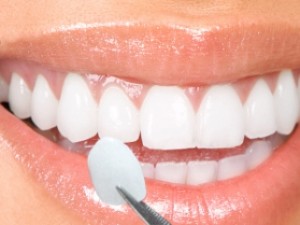 colore faccette dentali