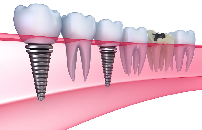 impianti dentali