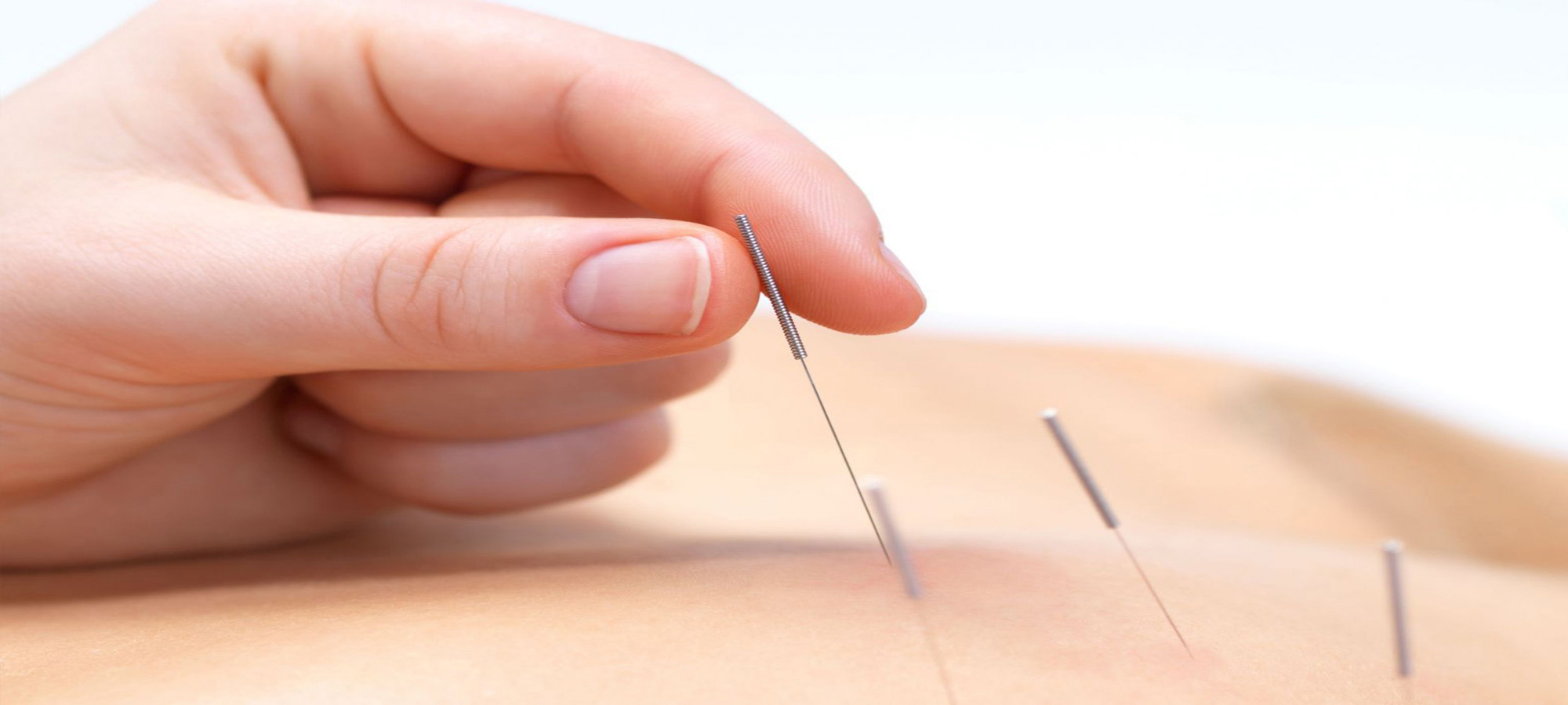 terapia agopuntura